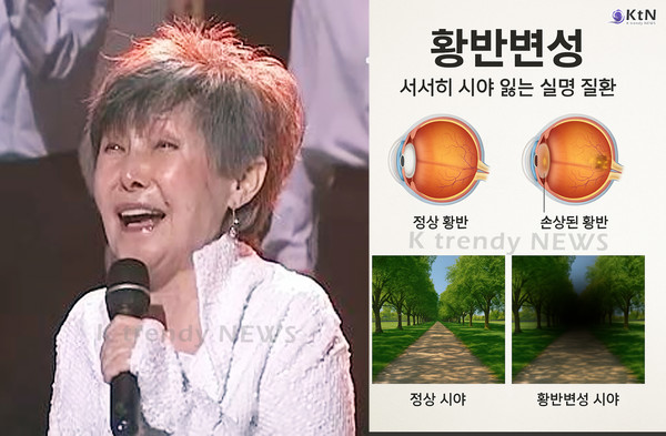 “주사 6번 맞았지만…” 79세 윤복희, 시력 잃게 한 질환의 정체는? 사진=2025 04.02 윤복희 - 여러분 KBS 230303 유튜브 갈무리  K trendy NEWS DB ⓒ케이 트렌디뉴스 무단전재 및 수집, 재배포금지